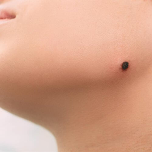 close up of a mole on person s face 2026 09 24 14 34 44 utc