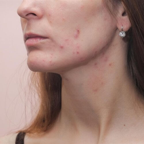 close up of woman s face with skin imperfections 2026 09 25 02 43 44 utc